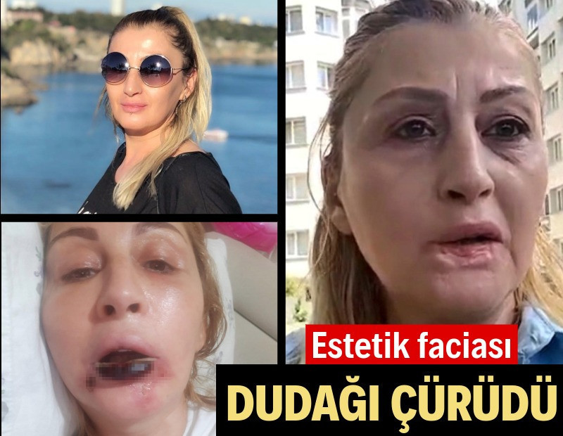 Estetik işlem sonrası dudağı çürüdü: Kabusu 7 yıldır bitmedi