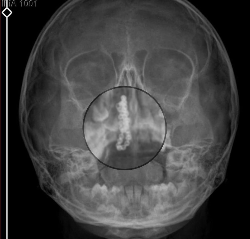 İki yıl burnunda tırnak makası zinciriyle yaşamış - Resim : 1