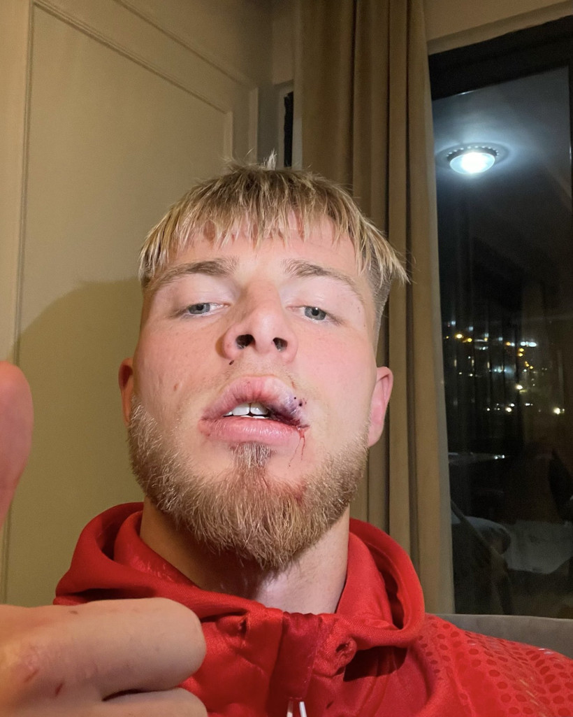 Galatasaray maçında yaralanmıştı: Van Drongelen'in dudağına 8 dikiş atıldı - Resim : 1