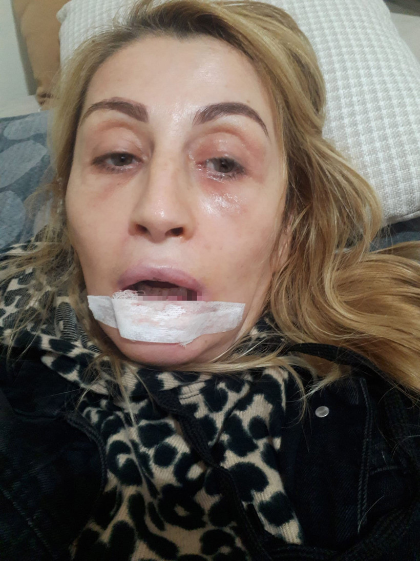 Estetik işlem sonrası dudağı çürüdü: Kabusu 7 yıldır bitmedi - Resim : 3