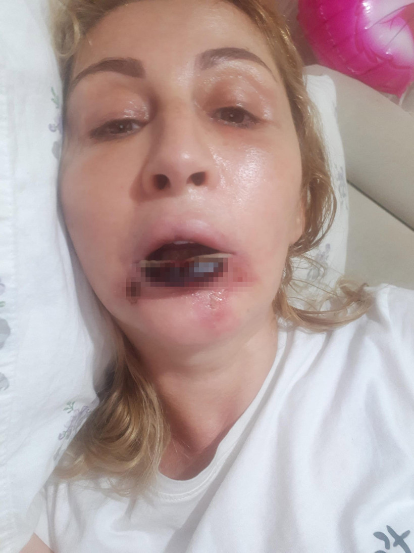 Estetik işlem sonrası dudağı çürüdü: Kabusu 7 yıldır bitmedi - Resim : 2