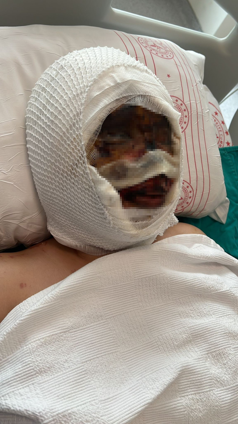 Ayrıldığı kadını bantlayıp kafasına kezzap d&ouml;kt&uuml; - Resim : 1