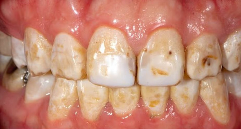 Uzmanlar anlattı: Diş renginiz hangi hastalığın habercisi? - Resim: 4