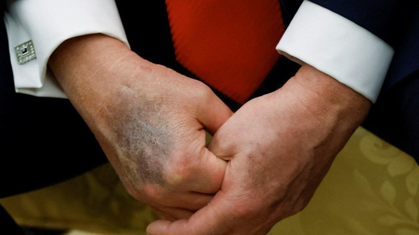 Beyaz Saray'dan Trump'ın eliyle ilgili açıklama geldi - Resim: 5