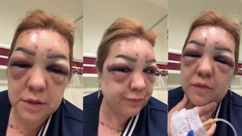 Güzellik uğruna tanınmayacak hale geldi - Resim : 2