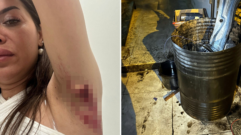 Yola dökülen yağ davalık oldu: ‘Kolumu kaybedebilirdim’ - Resim : 2