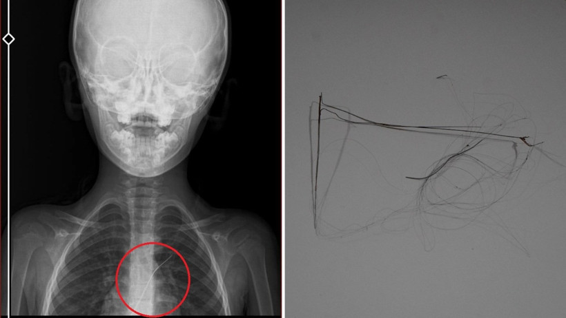 3 yıl sonra fark edildi: 6 yaşındaki çocuğun vücudunda kateter unutulmuş - Resim : 1