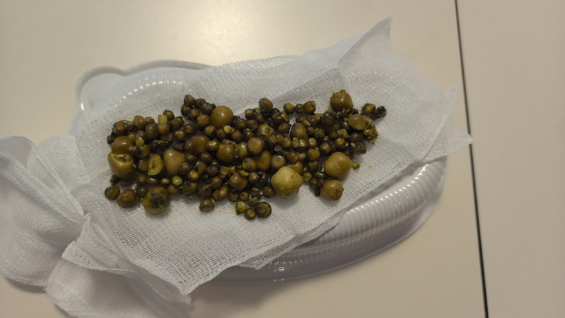 Karın ağrısıyla hastaneye gitti, safra kesesinden 213 taş çıktı - Resim : 1