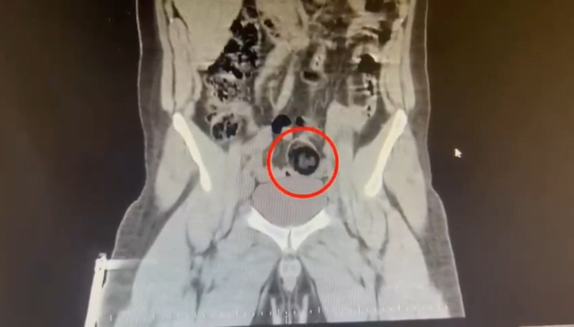 İranlı yolcu makatına uyuşturucu saklamış - Resim : 1