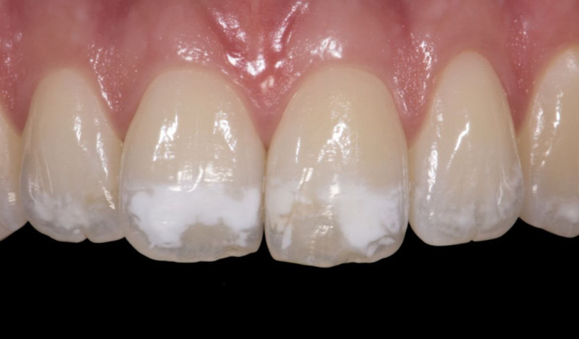 Uzmanlar anlattı: Diş renginiz hangi hastalığın habercisi? - Resim: 6