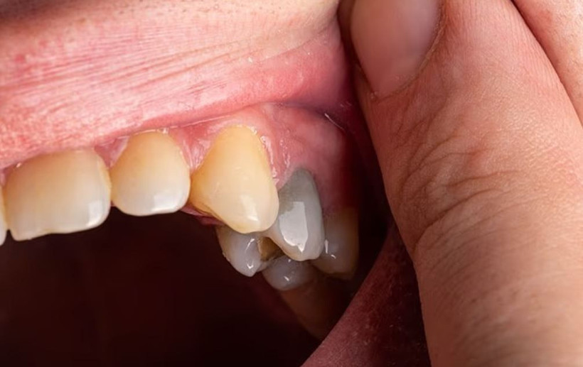 Uzmanlar anlattı: Diş renginiz hangi hastalığın habercisi? - Resim: 3