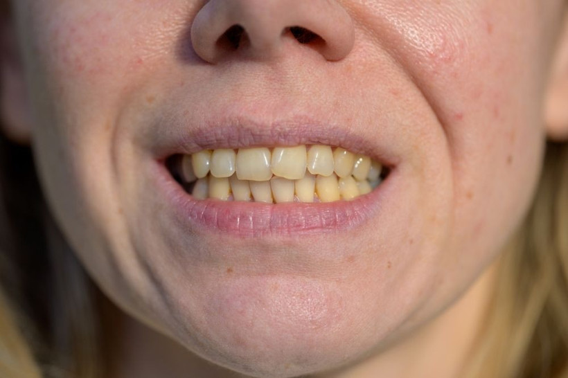Uzmanlar anlattı: Diş renginiz hangi hastalığın habercisi? - Resim: 2