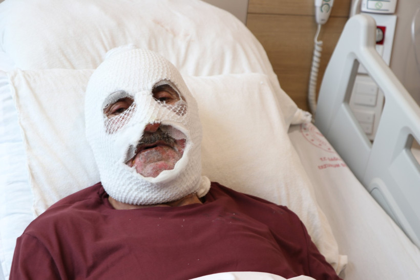 Gaz kaçağını çakmakla kontrol ederken yandı - Resim : 1