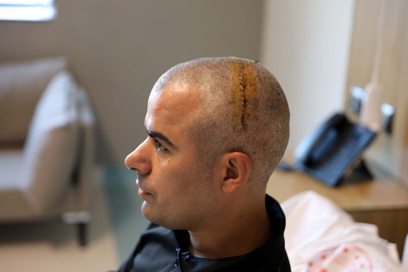 Doktorla konuşarak beyin ameliyatı oldu: Tümör böyle çıkarıldı - Resim : 2