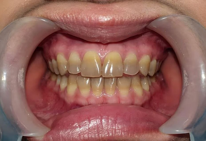 Uzmanlar anlattı: Diş renginiz hangi hastalığın habercisi? - Resim: 5