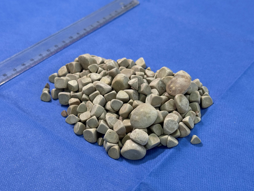 Bir ameliyatta 287 taş çıkarıldı - Resim : 1