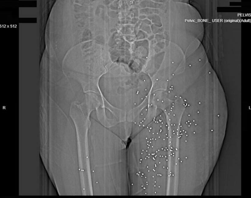 Protestoculara şiddetin boyutu röntgenlerde çıktı - Resim : 2
