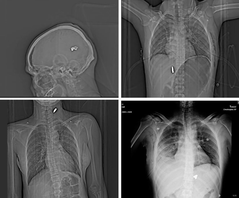 Protestoculara şiddetin boyutu röntgenlerde çıktı - Resim : 1