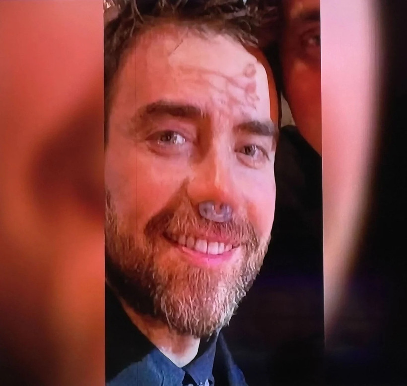 Murat Dalkılıç 12. kez burun ameliyatı oldu! Son hali ortaya çıktı - Resim : 1