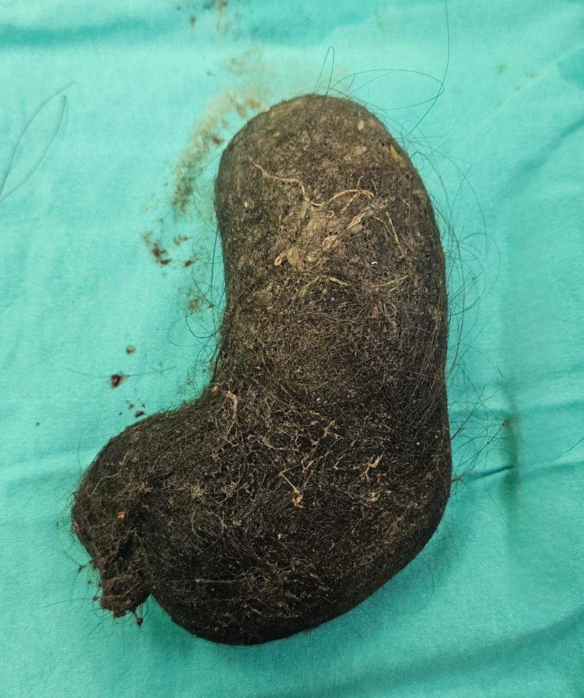 Aileler dikkat: 9 yaşındaki çocuğun midesinden çıktı - Resim : 2